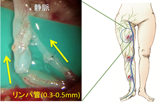 局所麻酔下・リンパ管静脈吻合術（保険適応）