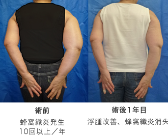 代表症例(右乳がん術後の上肢リンパ浮腫)